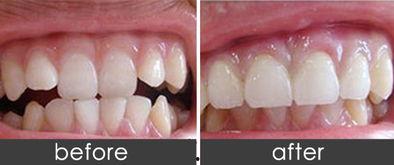 成人矫正隐适美牙齿视频,见证微笑蜕变之旅