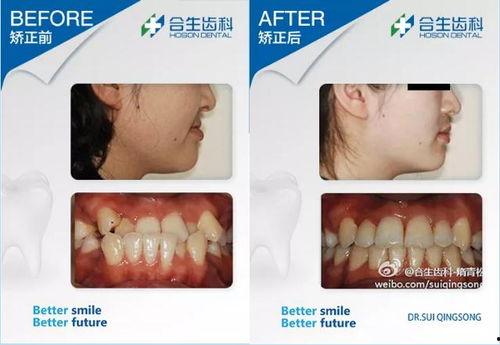 成人矫正隐适美牙齿视频,见证微笑蜕变之旅