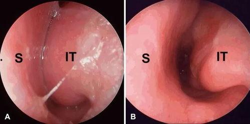 成人冲洗鼻腔教程视频大全,轻松掌握健康呼吸技巧